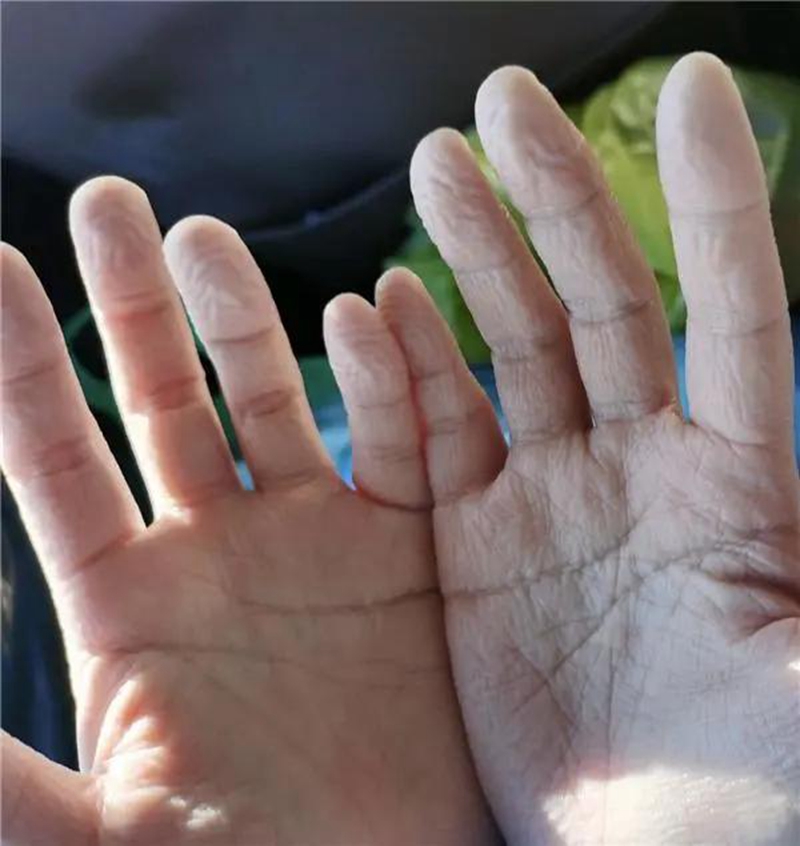 摘下手套双手已被汗水泡肿.jpg